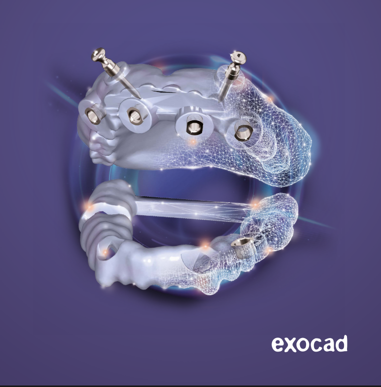 Esta en flujo exocad exoplan